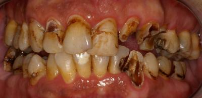 caries_imagen3.jpg